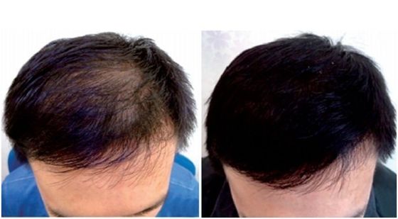 ABS Diodes Hair Regrowth Laser Cap For Anti Hair Loss