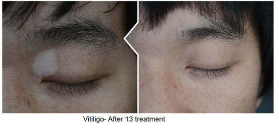 308nm Targeted Laser Treatment Vitiligo Excimer Light Phototherapy