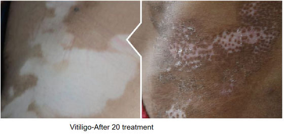 Blue Excimer Laser Technology FDA CE Vitiligo Laser Treatment