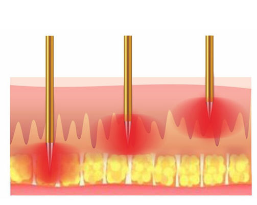 Fractional Rf For Acne Scars Radio Frequency Face Lift Machine Skin Tightening Machine