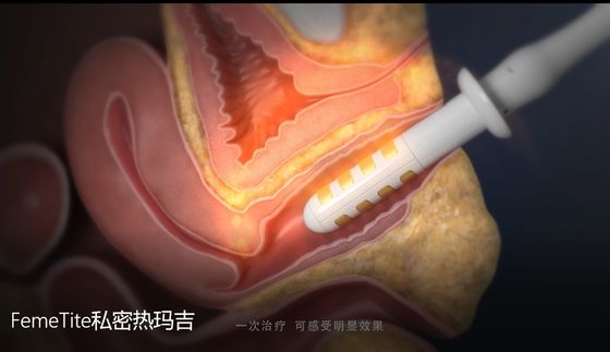 Tress Urinary Radio Frequency Therapy Incontinence Vaginal Rejuvenation Clinical Studies