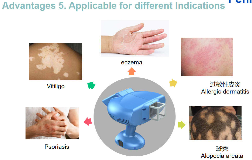 Homeuse 308NM Excimer Light Treatment Treat Vitiligo / Psoriasis